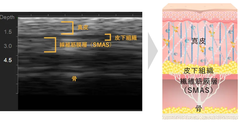 SMAS層へのアプローチイメージ