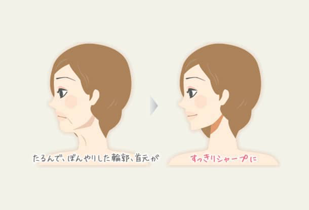 輪郭形成ボトックスの図