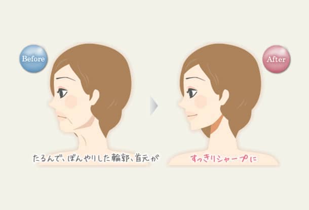 輪郭形成ボトックスの図