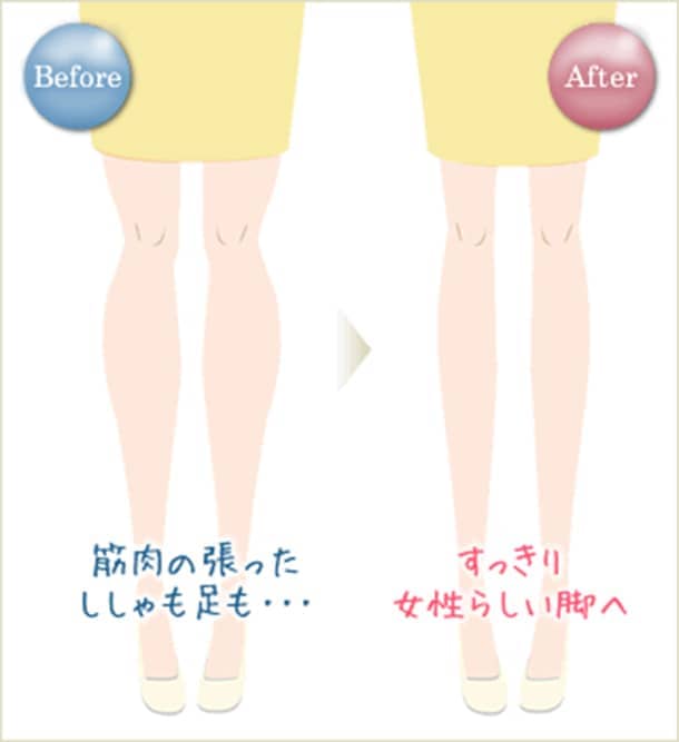 輪郭形成ボトックスの図