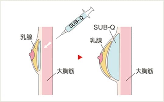 施術の図