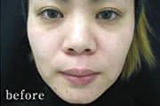 症例写真 before