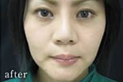 症例写真 after
