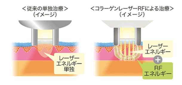 コラーゲンレーザーRFによる治療の図