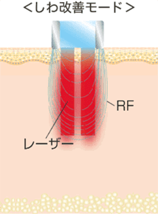 しわ改善モードの図