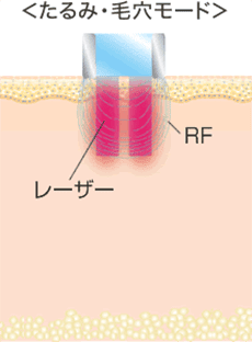 たるみ・毛穴モードの図