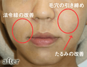 症例写真1 施術後