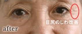 症例写真2 施術後