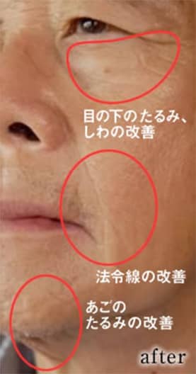 症例写真2 施術後