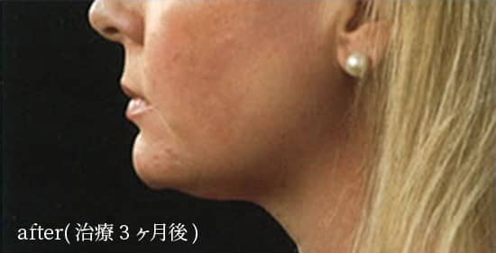 after（治療3ヶ月後）