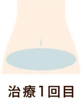 治療部位腹部 治療1回目