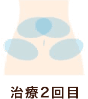 治療部位腹部 治療2回目