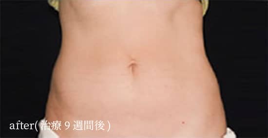 after（治療9週間後）
