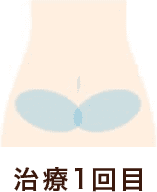治療部位腹部 治療1回目
