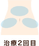 治療部位腹部 治療2回目