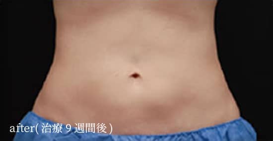after（治療9週間後）