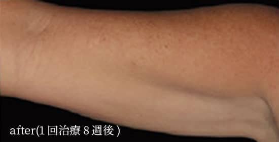 after（1回治療治療8週間後）