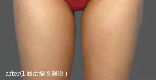 after（1回治療治療8週間後）