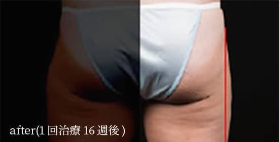 after（1回治療治療16週間後）