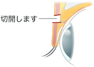 切開の図