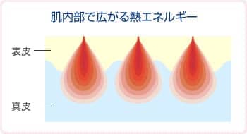 肌内部で広がる熱エネルギー・表皮・真皮