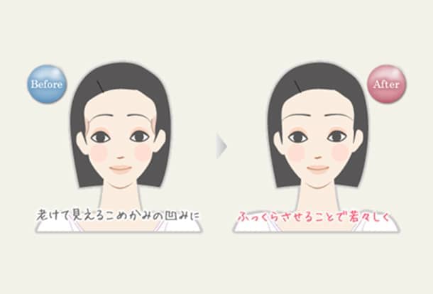 こめかみのヒアルロン酸注入の図