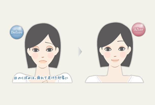 目のくぼみ ヒアルロン酸注入法の図