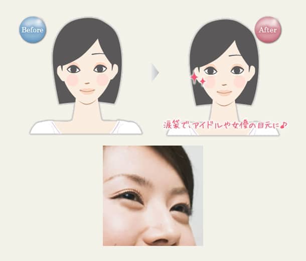 涙袋 ヒアルロン酸注入の図