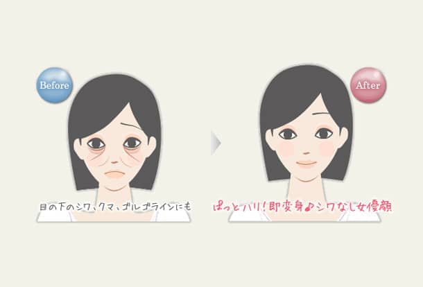 目の下のクマ・ゴルゴライン ヒアルロン酸注入法の図
