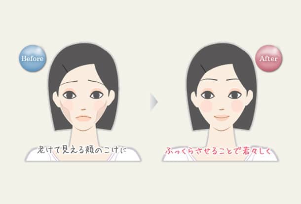 頬のこけ ヒアルロン酸注入法の図