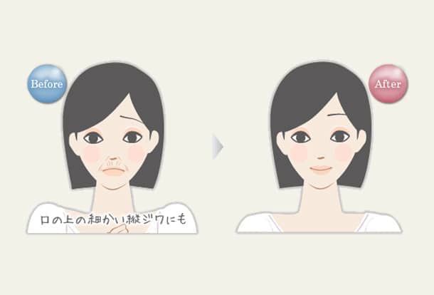 口の上の縦ジワ 若見えヒアルロン酸注入法の図