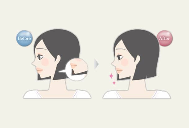 アゴ ヒアルロン酸注入法の図