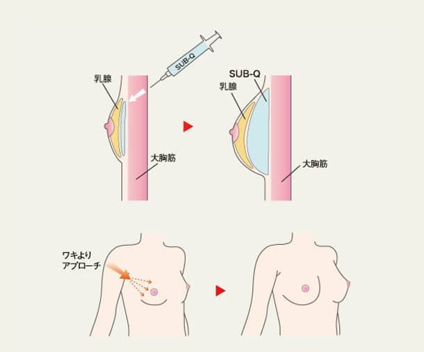 豊胸術（SUB-Q）の図