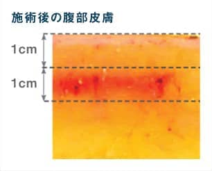 施術後の腹部皮膚