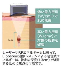 レーザーやRFエネルギーとは違って、Liposonix治療システムによる超音波エネルギーは、特定の深度（1.3cm）で処置するために焦点化可能です。