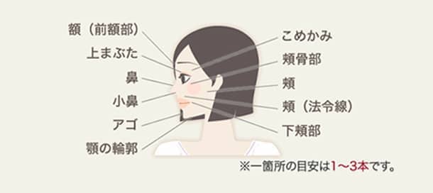 BNLS注射の施術可能箇所の図1