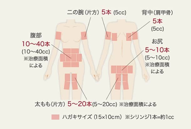 BNLS注射の施術可能箇所の図2