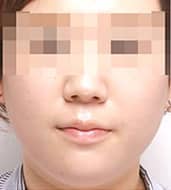 症例写真 before