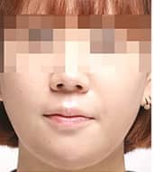 症例写真 after