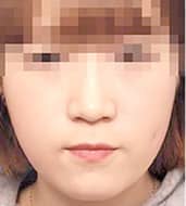 症例写真 after