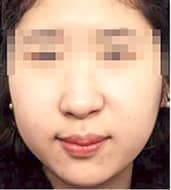 症例写真 before