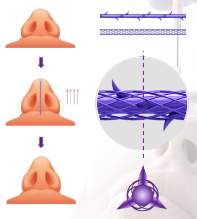 NOSE MESH SCAFFOLDS