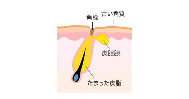 ケミカルピーリングとはの図1