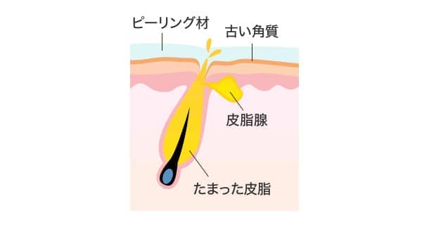 ケミカルピーリングとはの図2