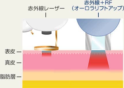 従来の光治療・オーロラリフトアップ比較図