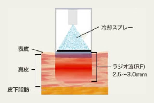 サーマクールのラジオ波画像