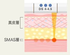 DS 4-4.5 真皮層・SMAS層