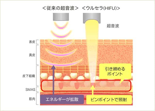 従来の超音波はエネルギーが拡散するのに対し、ウルセラ（HIFU）はピンポイントで照射する