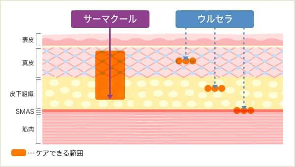 サーマクールとウルセラのケアできる範囲のイメージ