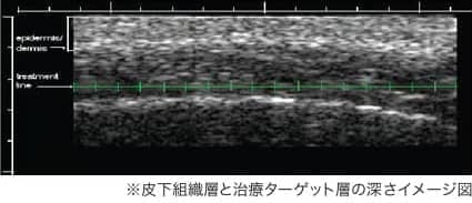 皮下組織層と治療ターゲット層の深さイメージ図